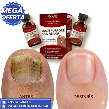German ToenaliPlus™: Aceite de Alivio Inmediato para la Paroniquia (25ml) X3